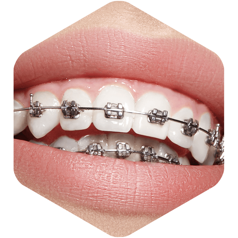 Female with metal braces.